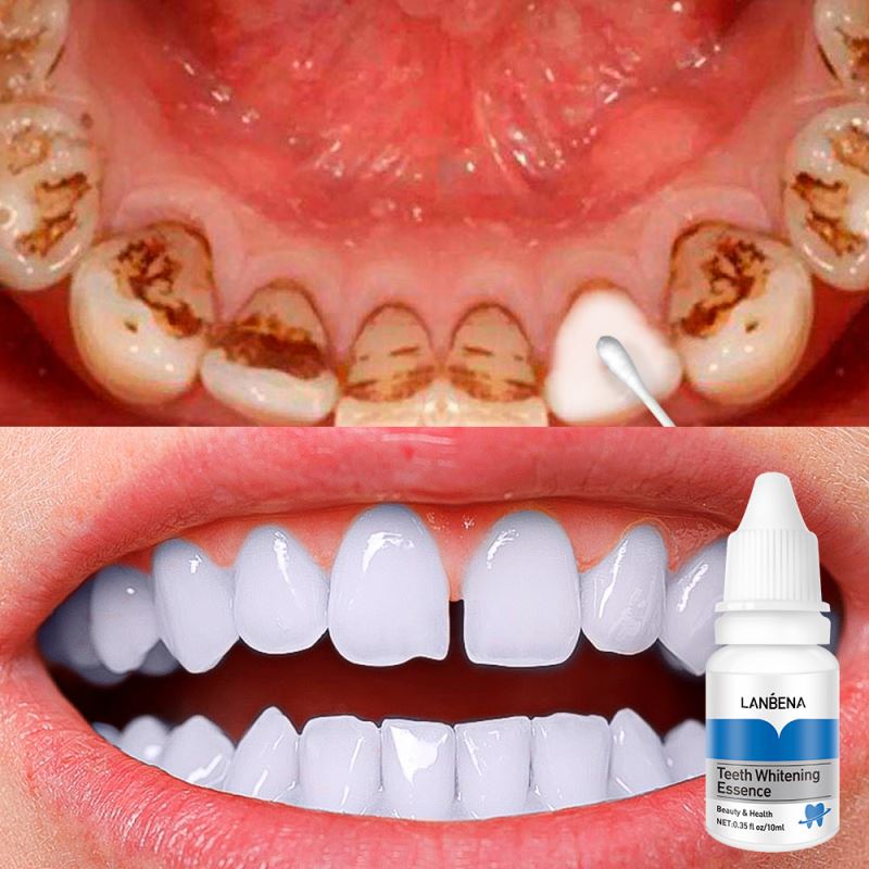 LANBENA professional teeth whitening essence liquid