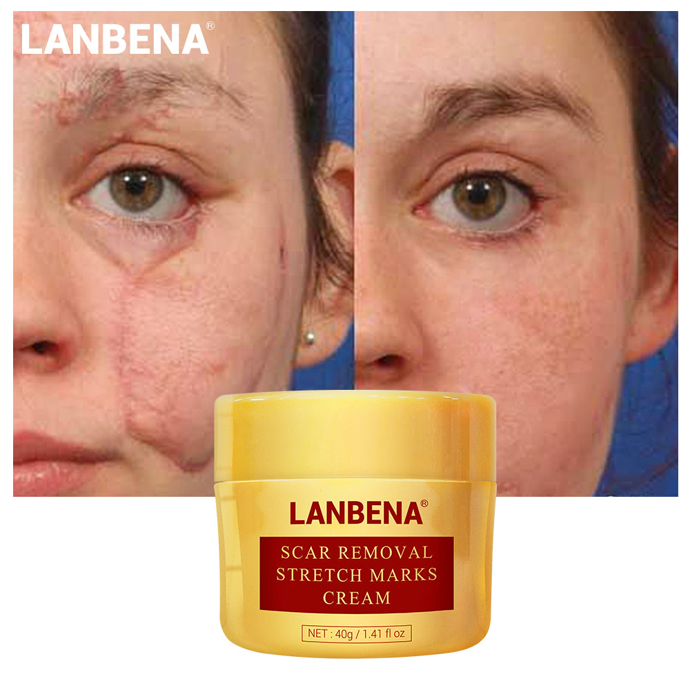 LANBENA Scar Removal Cream Acne Scars and Stretchmarks Treatment Cream